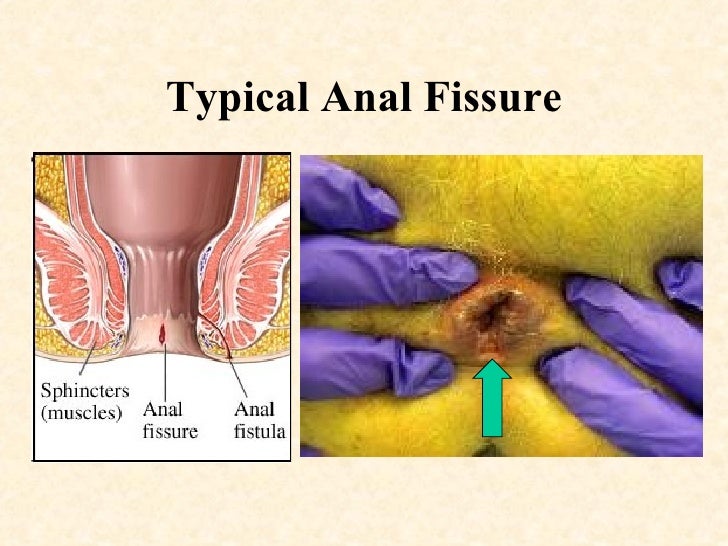 nitroglycerin anal fissures Hot nude blonde milf ass